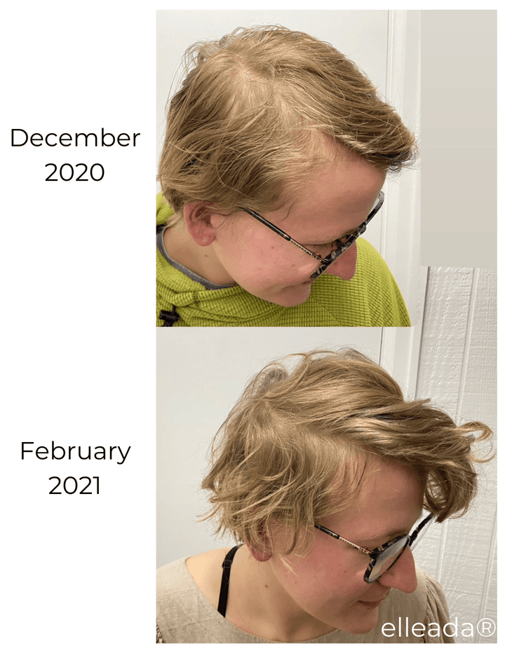 Elleada Vegan Hair Strengthening Serum – Natural Relief for Hair Loss & Itchy Scalp