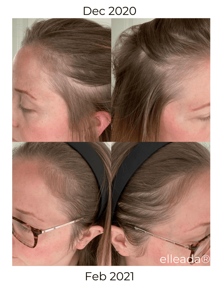 Elleada Vegan Hair Strengthening Serum – Natural Relief for Hair Loss & Itchy Scalp