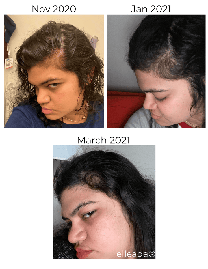 Elleada Vegan Hair Strengthening Serum – Natural Relief for Hair Loss & Itchy Scalp