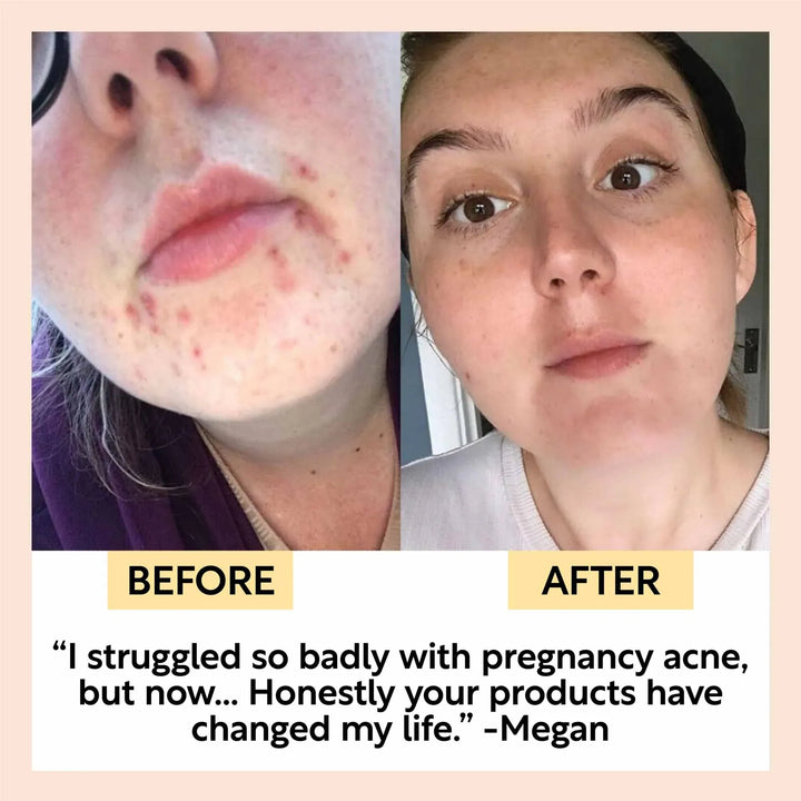 UpCircle The Acne-Prone Bundle